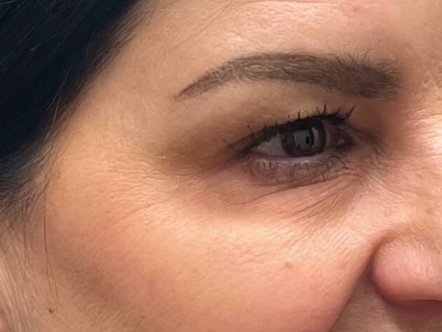 Botox crow's feet After