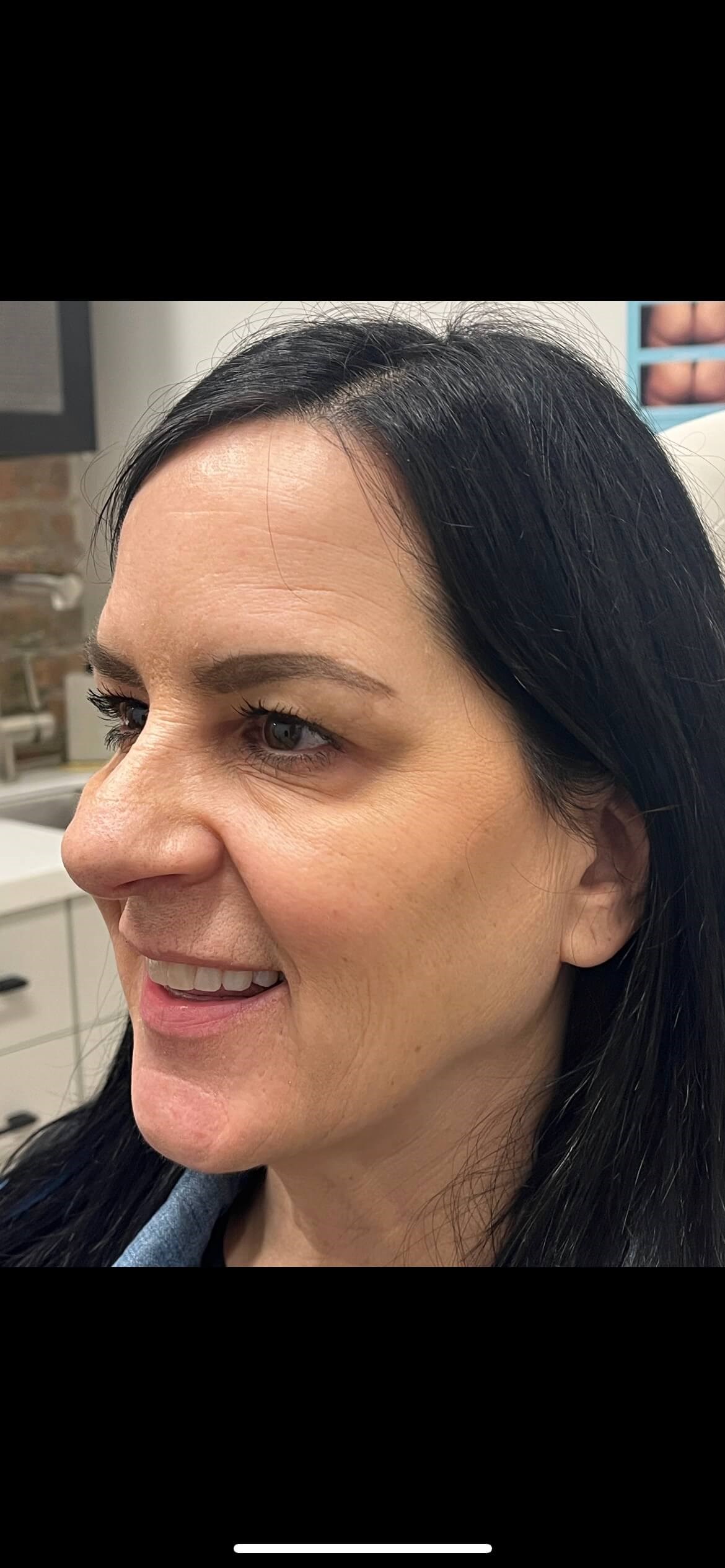 Botox crow's feet After