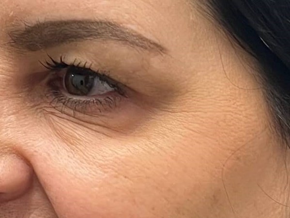 Botox crow's feet After
