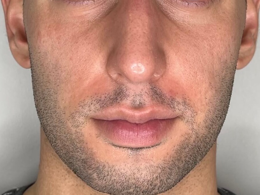 Sylfirm skin resurfacing Before