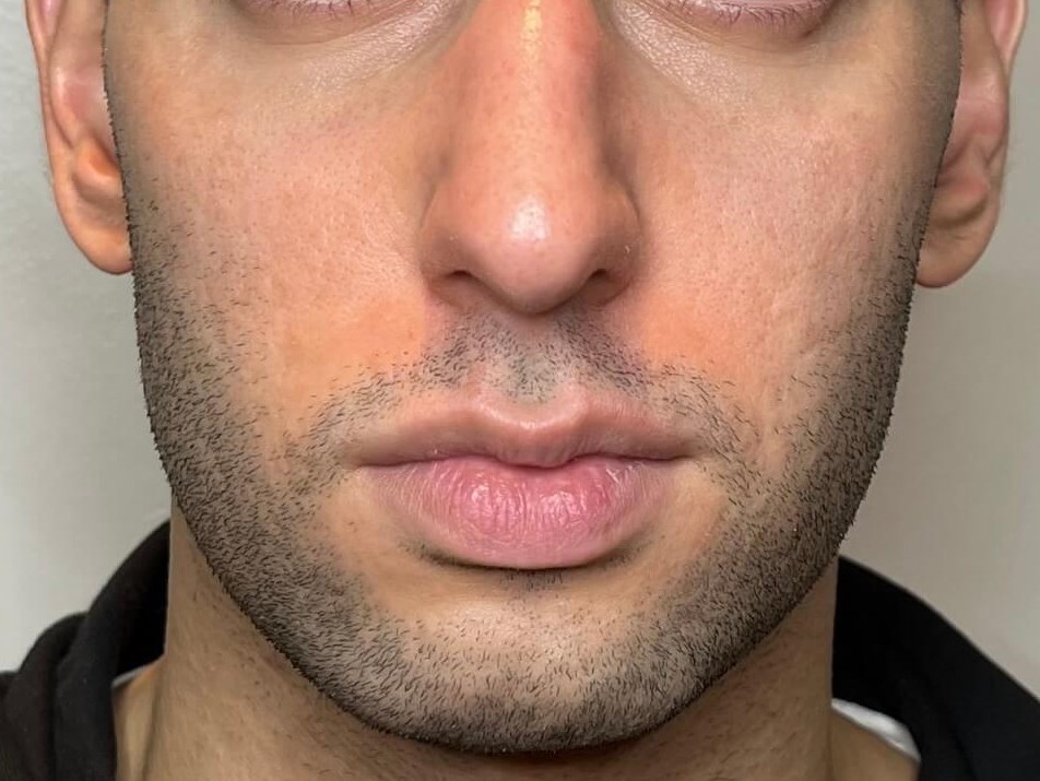 Sylfirm skin resurfacing After