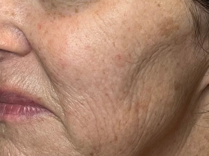 Halo Laser skin resurfacing Before