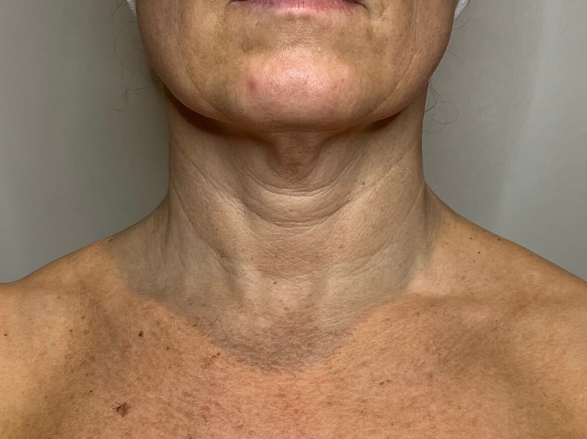 Sylfirm Skin Tightening Before