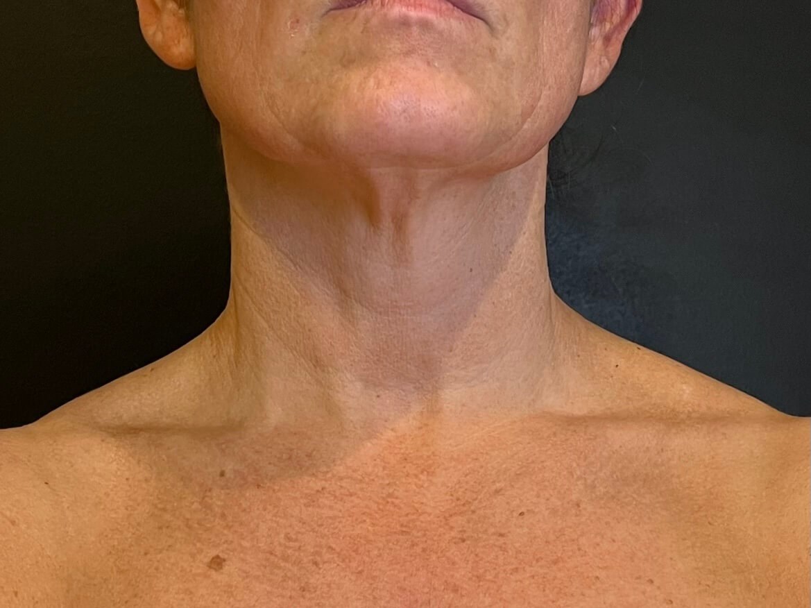 Sylfirm Skin Tightening After