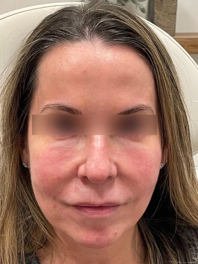 Juvederm Face Enhancement Before