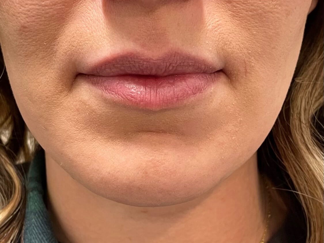 Juvederm Lip Enhancement Before