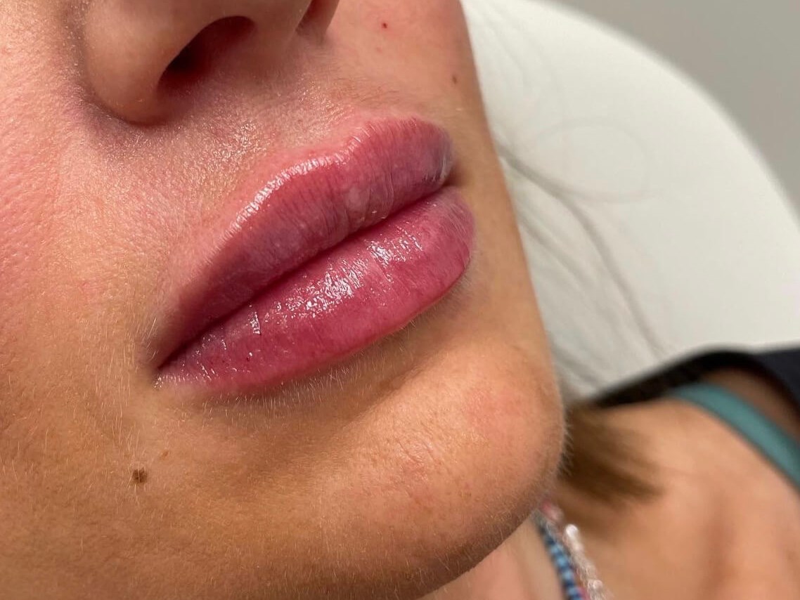 Juvederm Lip Enhancement After