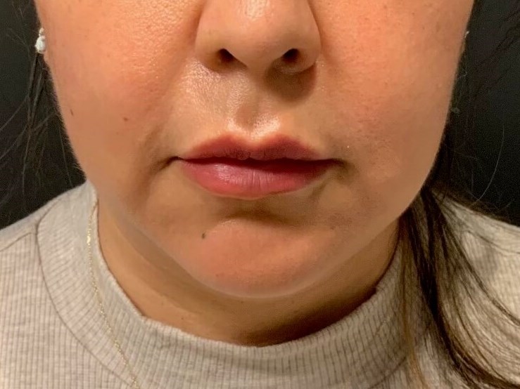 CoolSculpting  Chin After