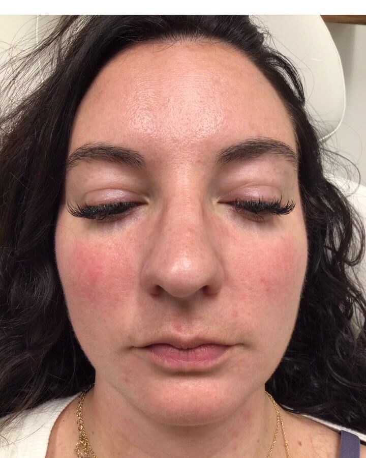 Juvederm Lip Enhancement Before