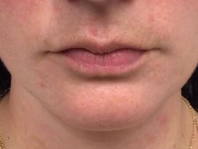 Juvederm Lip Enhancement Before