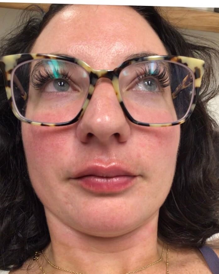 Juvederm Lip Enhancement After