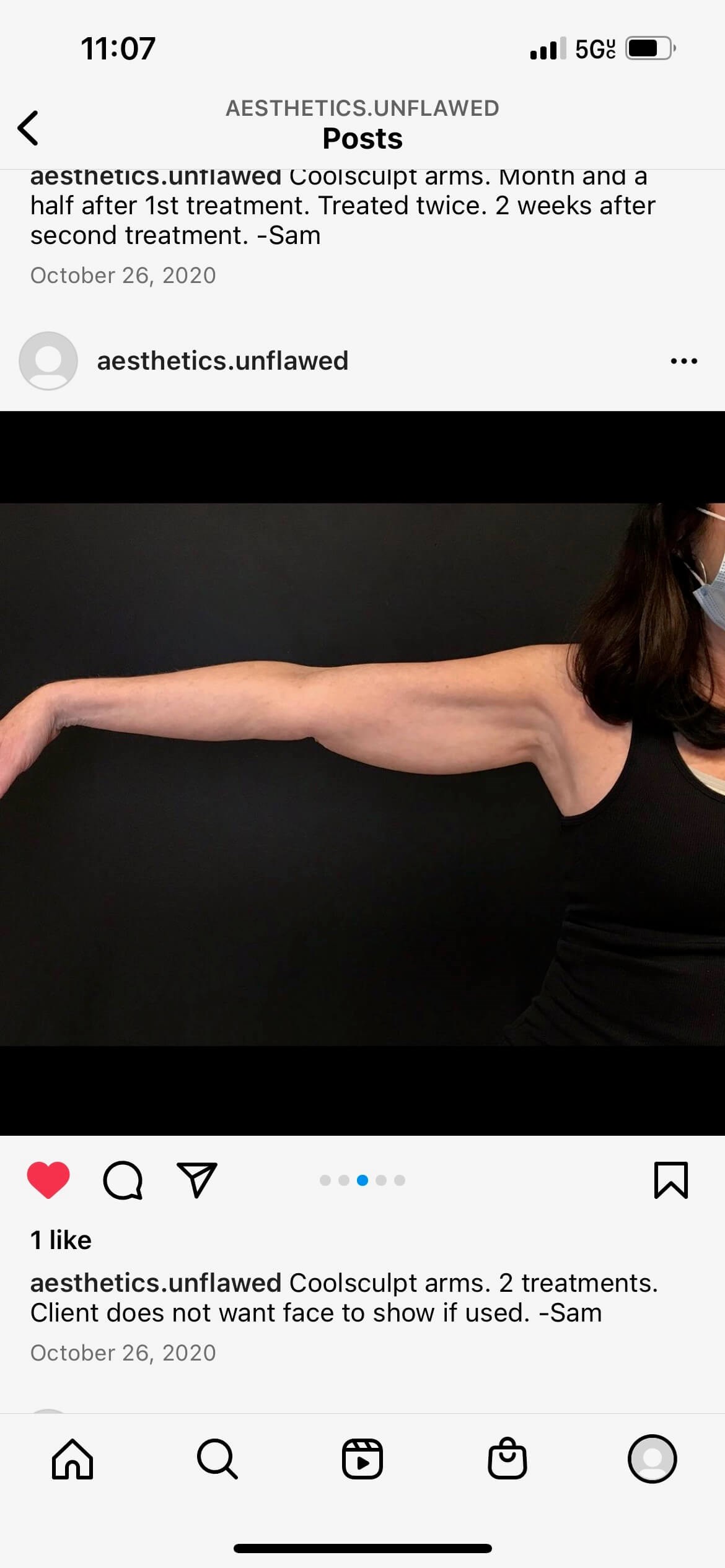 CoolSculpting Arms Before