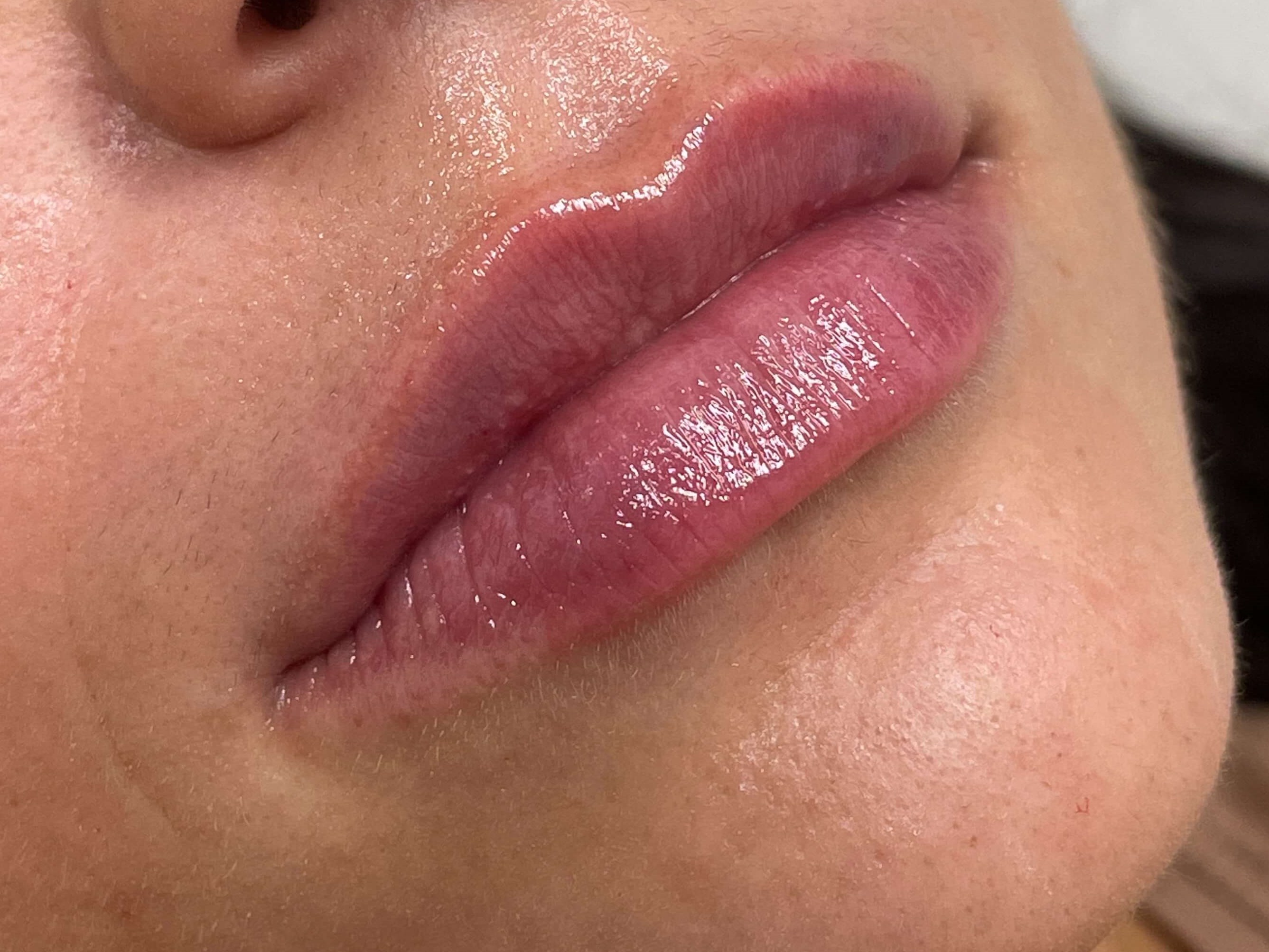 Juvederm Lip Enhancement After