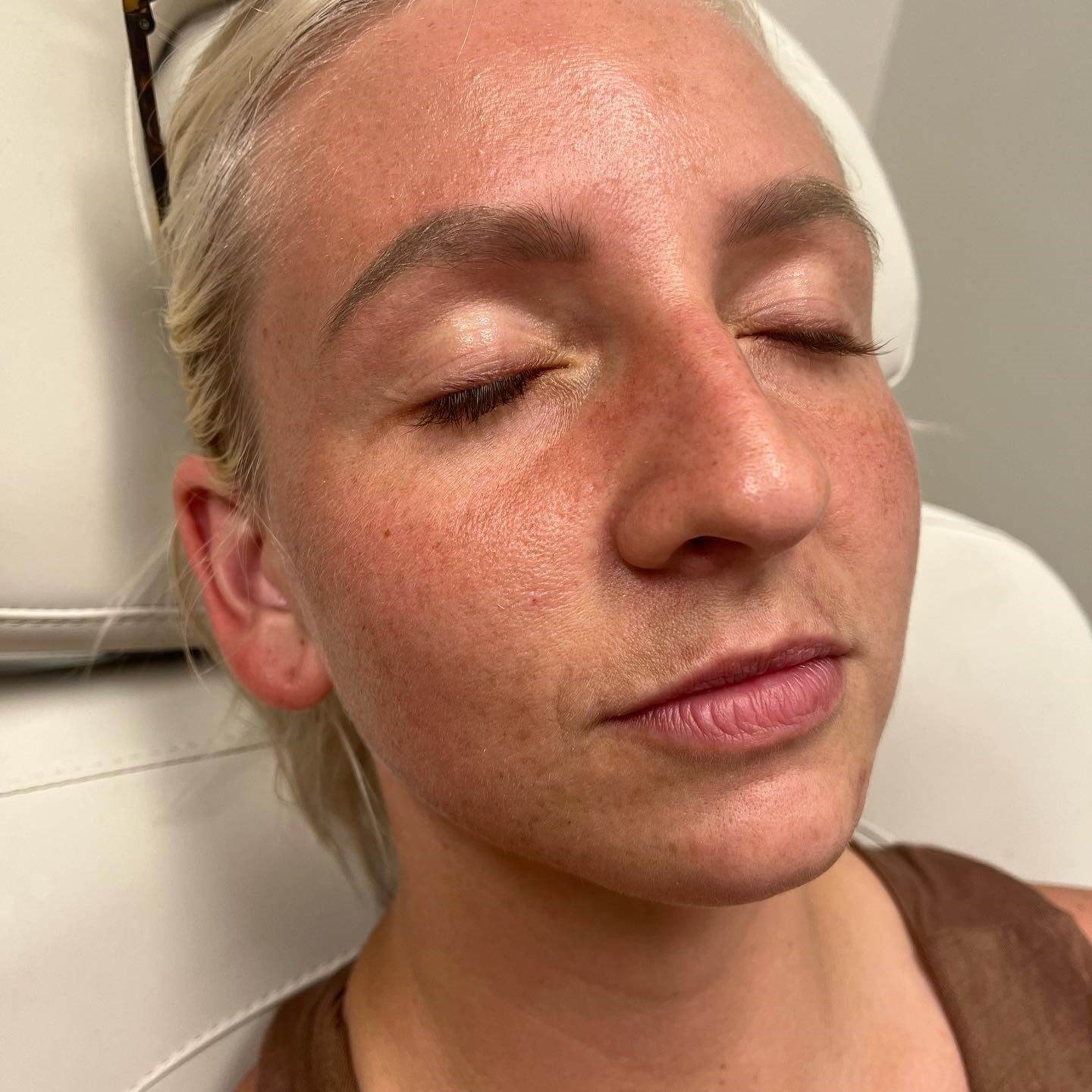 Juvederm Lip Enhancement Before