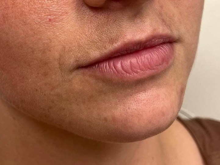 Juvederm Lip Enhancement Before