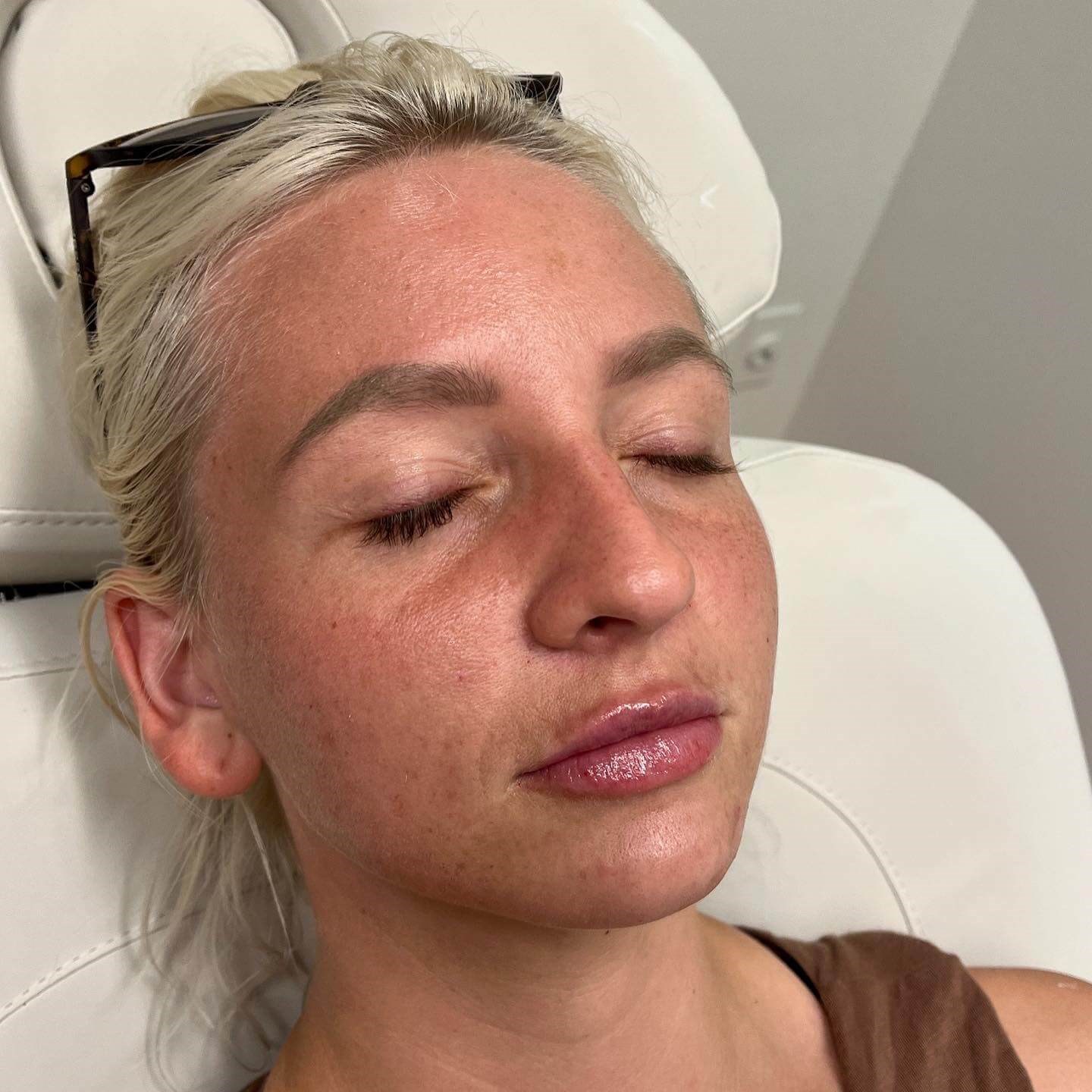 Juvederm Lip Enhancement After