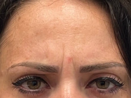 Botox forehead Before