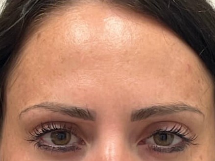 Botox forehead After