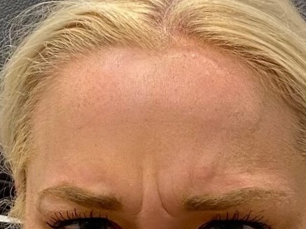 Botex Forehead Before