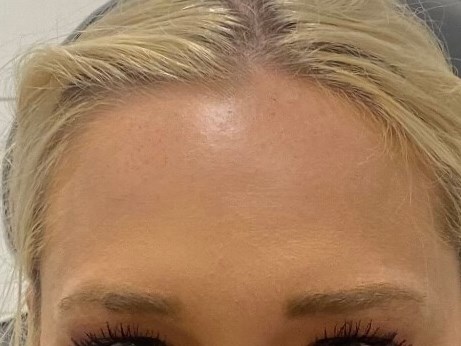 Botex Forehead After