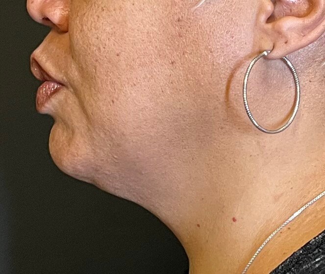 CoolSculpting  Chin Before