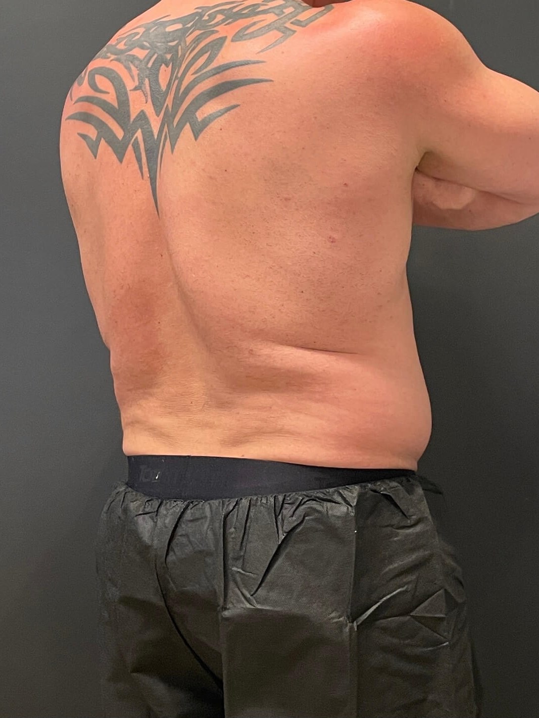 Cool Sculpting Flanks Before