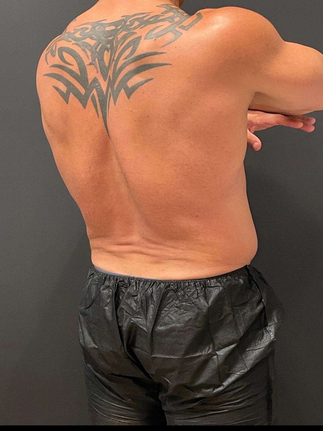 Cool Sculpting Flanks After