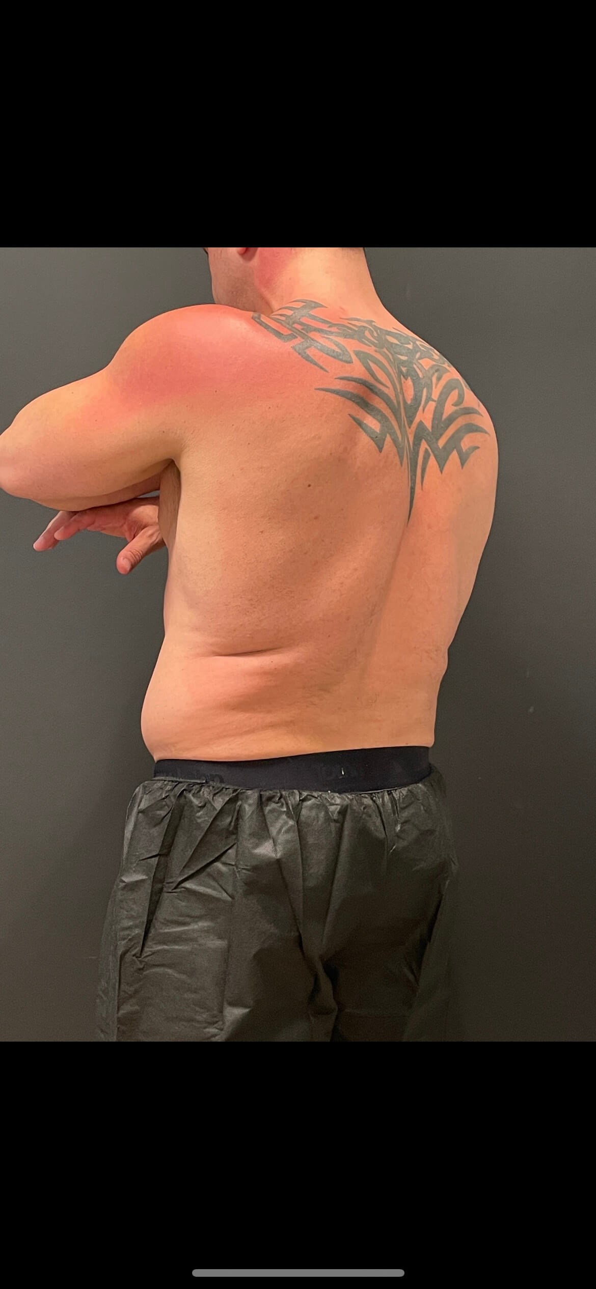 Cool Sculpting Flanks Before