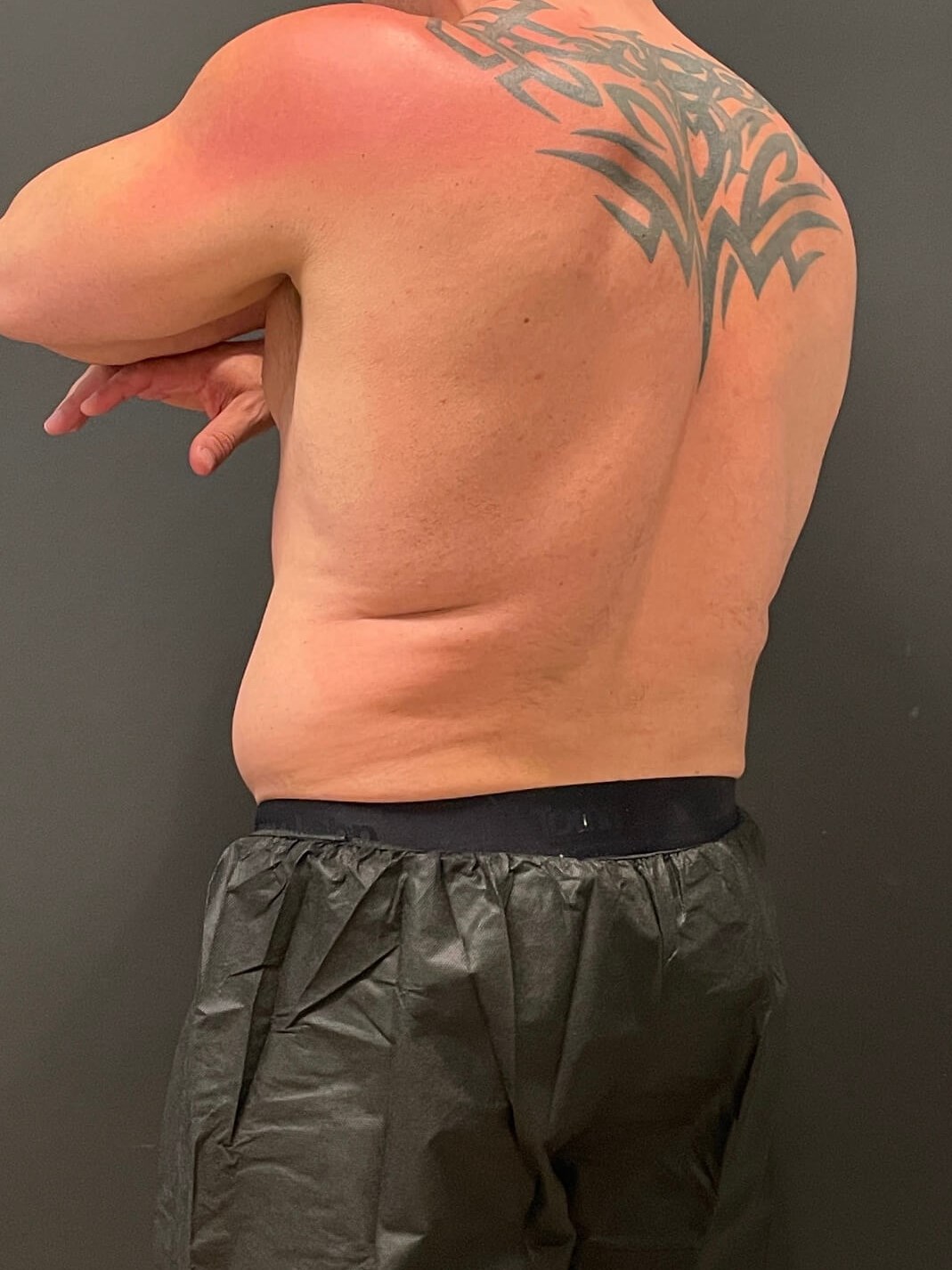 Cool Sculpting Flanks Before