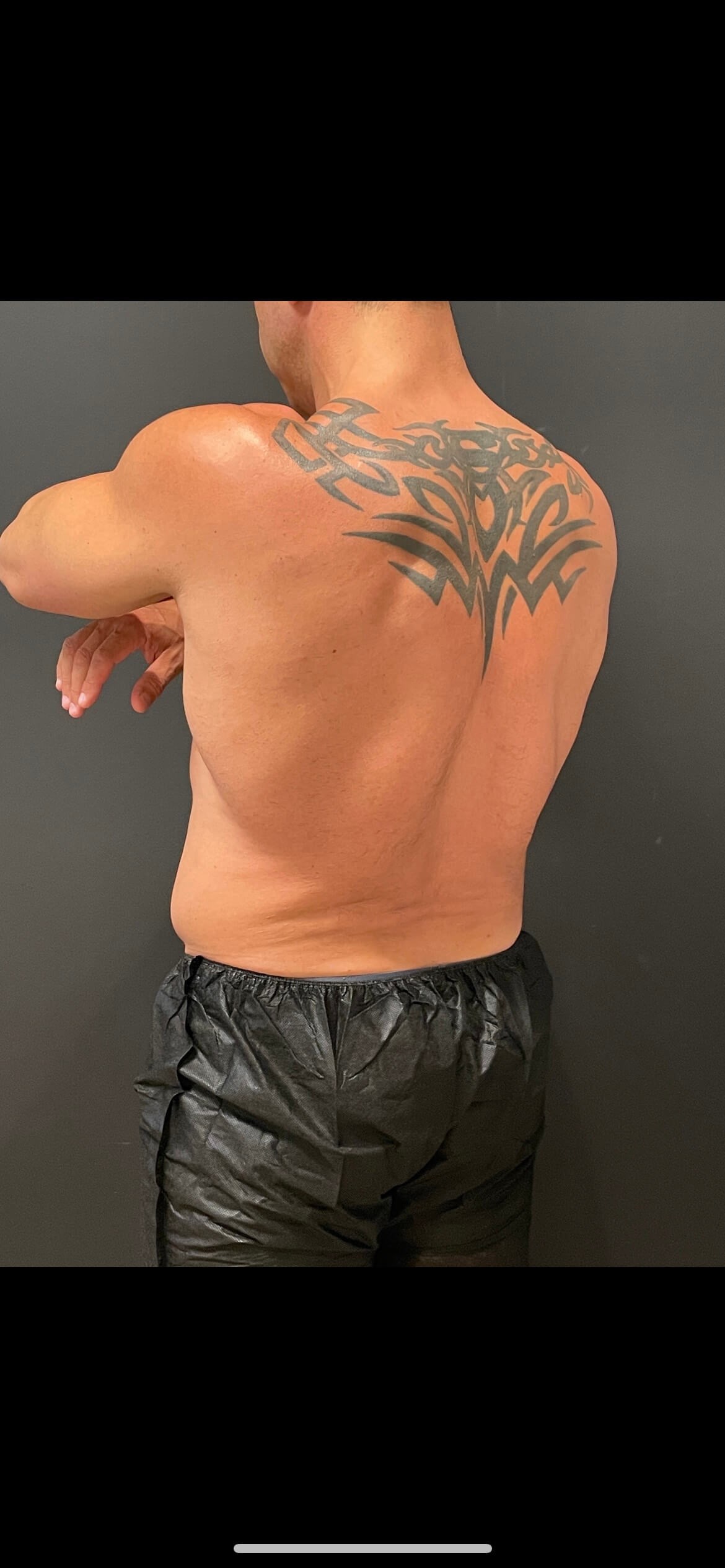 Cool Sculpting Flanks After