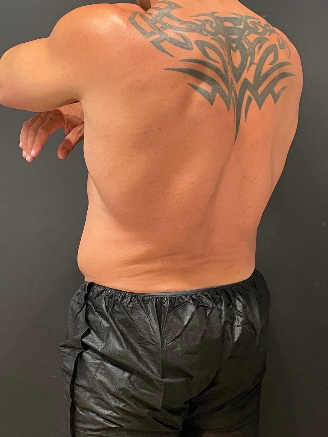 Cool Sculpting Flanks After