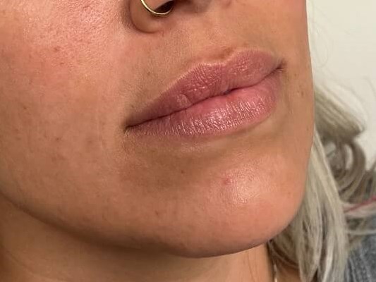 Juvederm Lip Enhancement Before