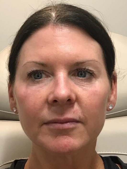 Juvederm Face Enhancement After