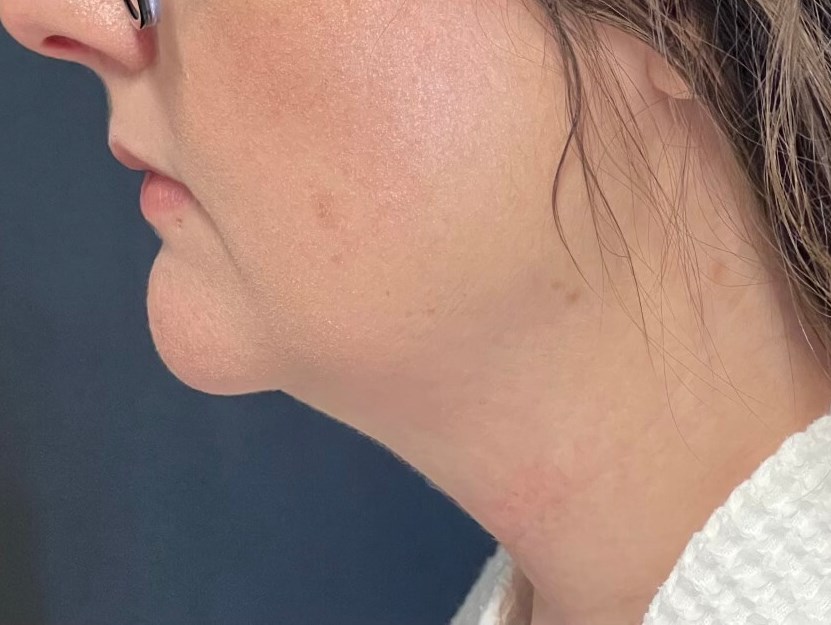 CoolSculpting  Chin Before
