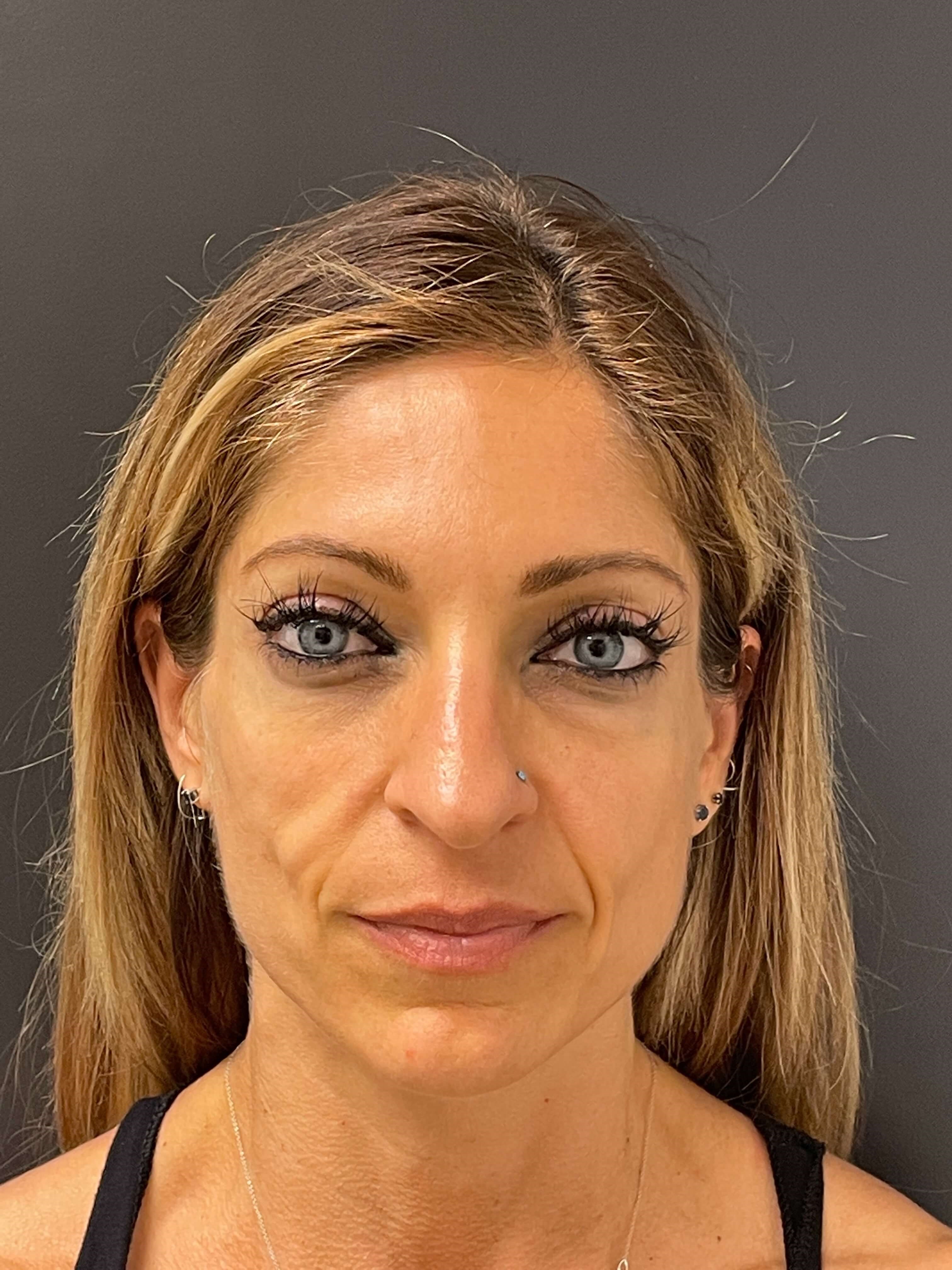 Sculptra Before