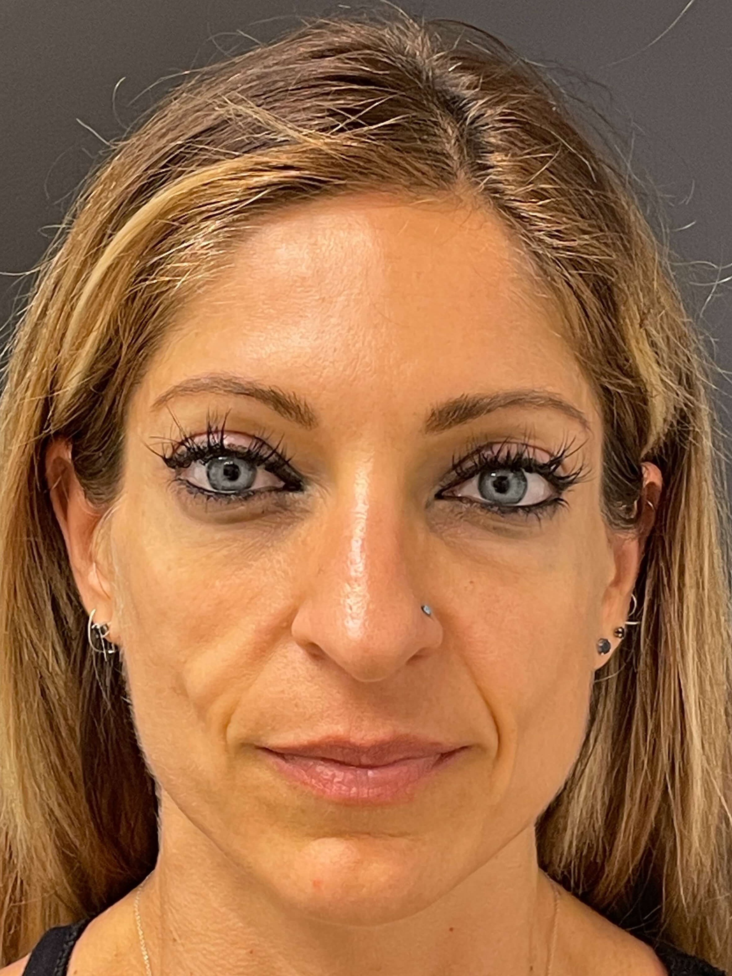 Sculptra Before