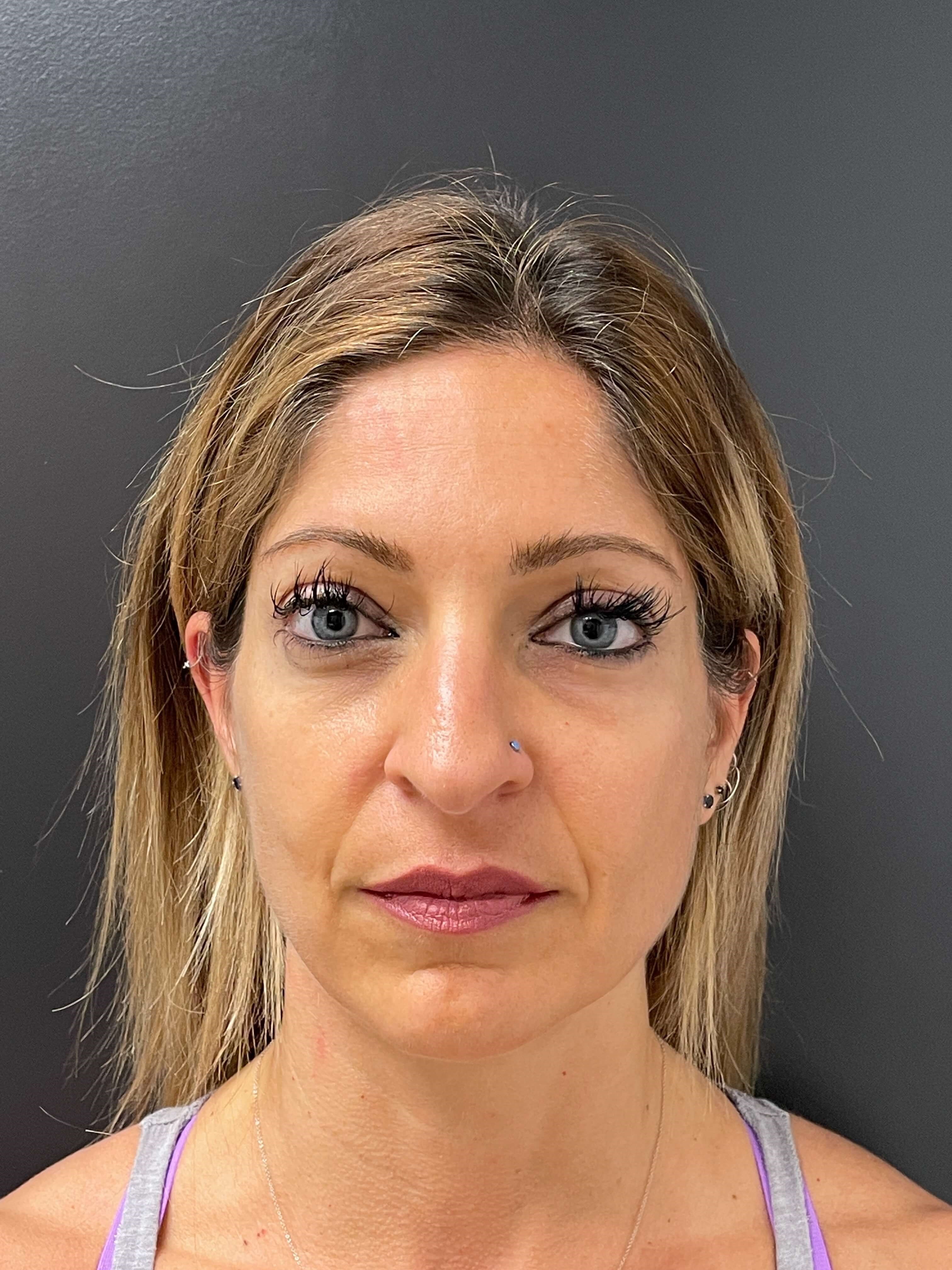 Sculptra After