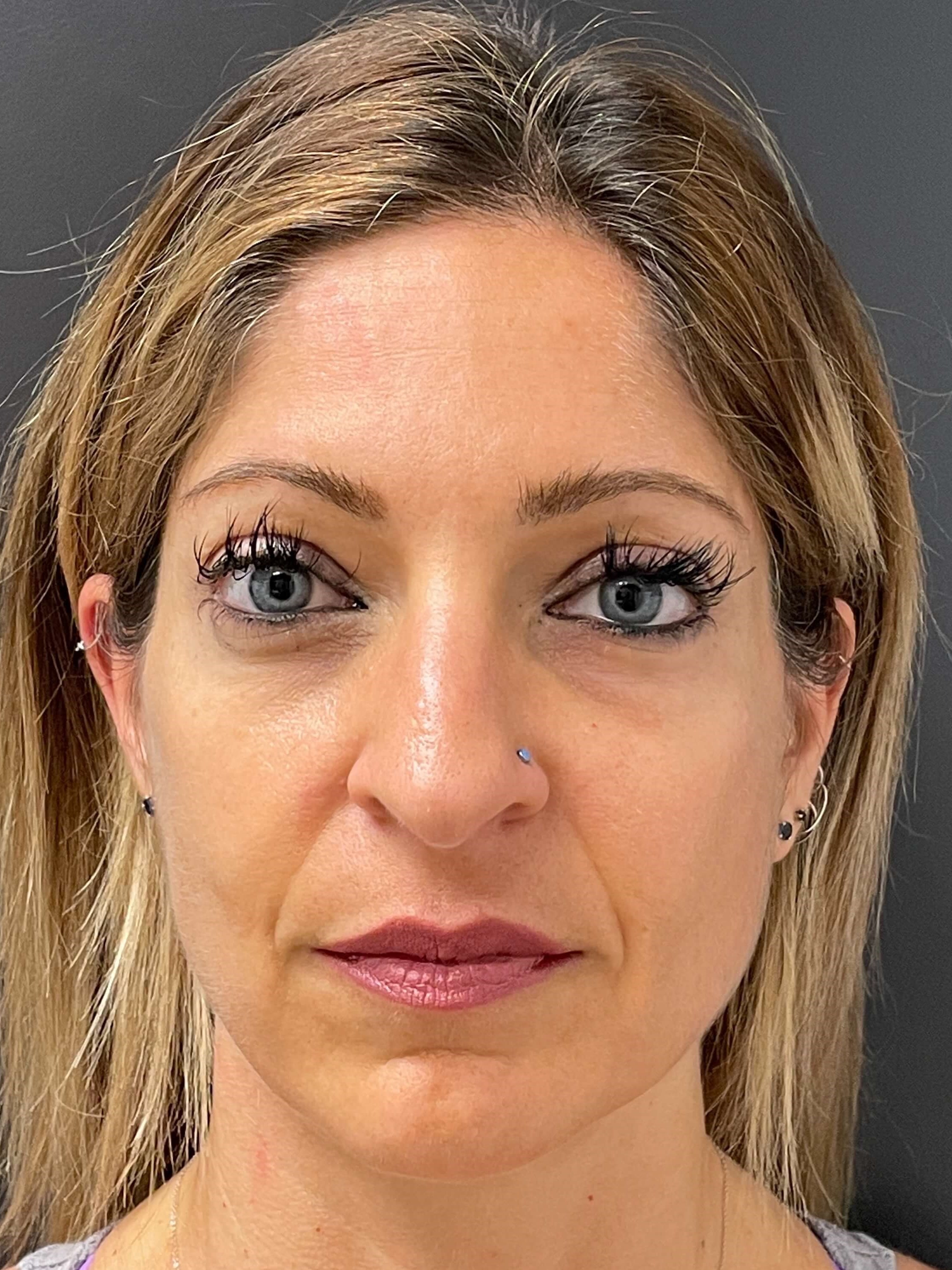 Sculptra After