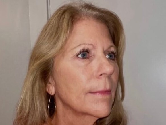 Sculptra Facial Enhancement After