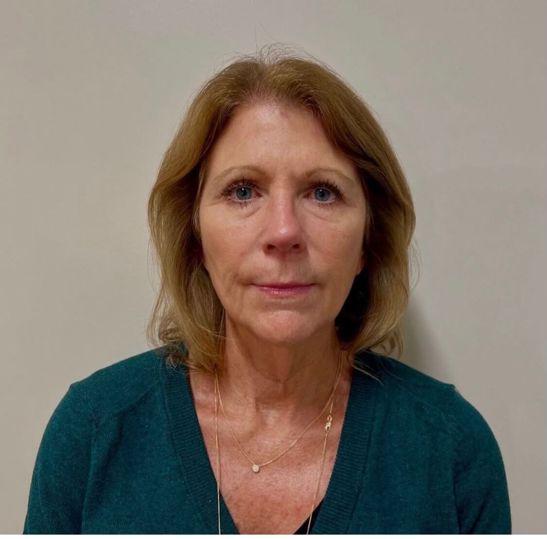 Sculptra Facial Enhancement Before