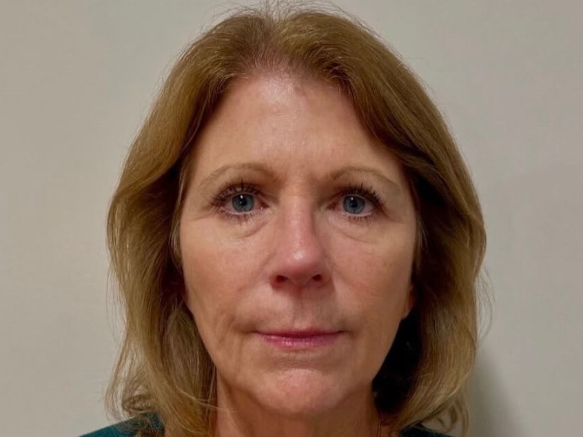 Sculptra Facial Enhancement Before