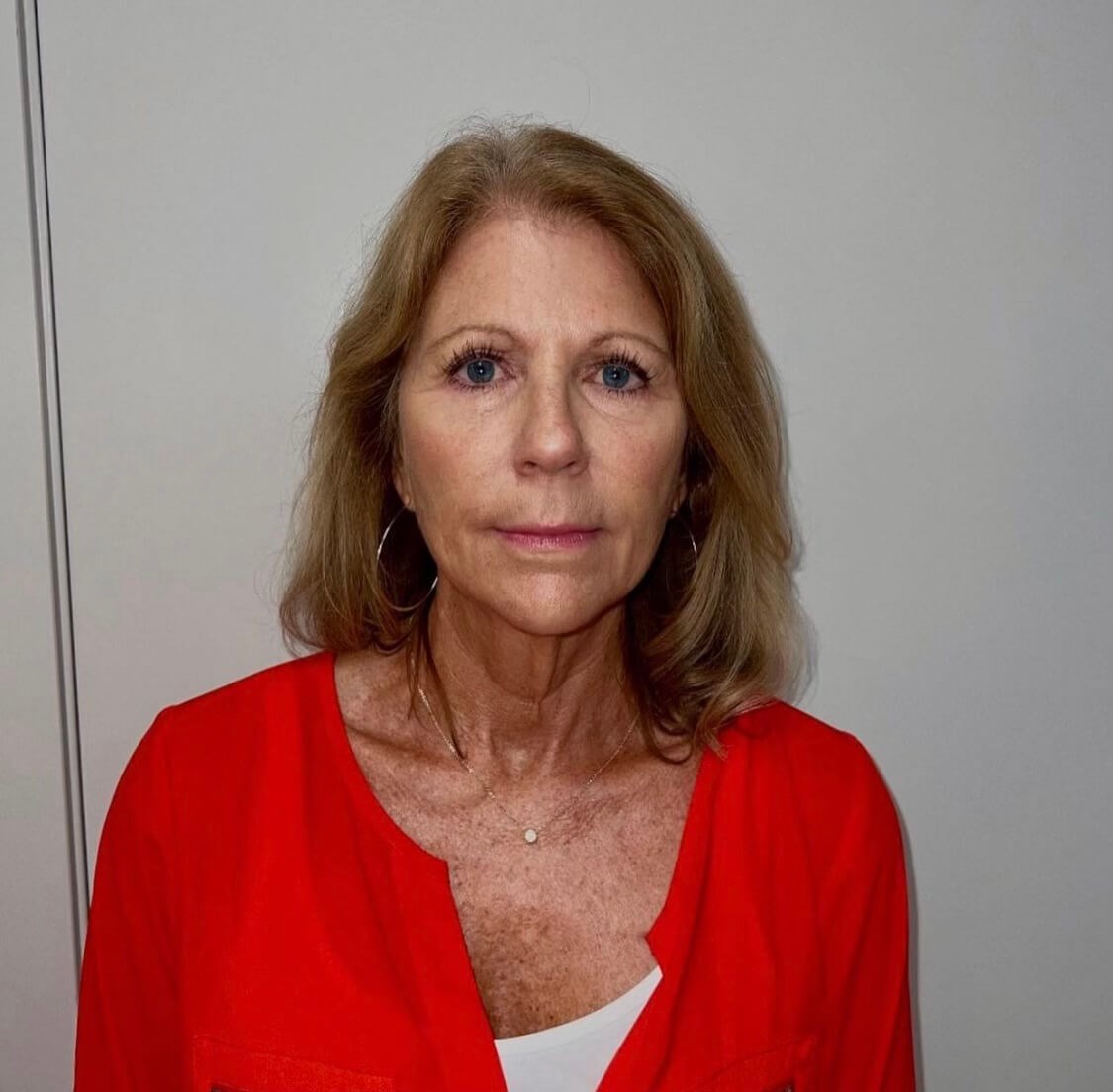 Sculptra Facial Enhancement After