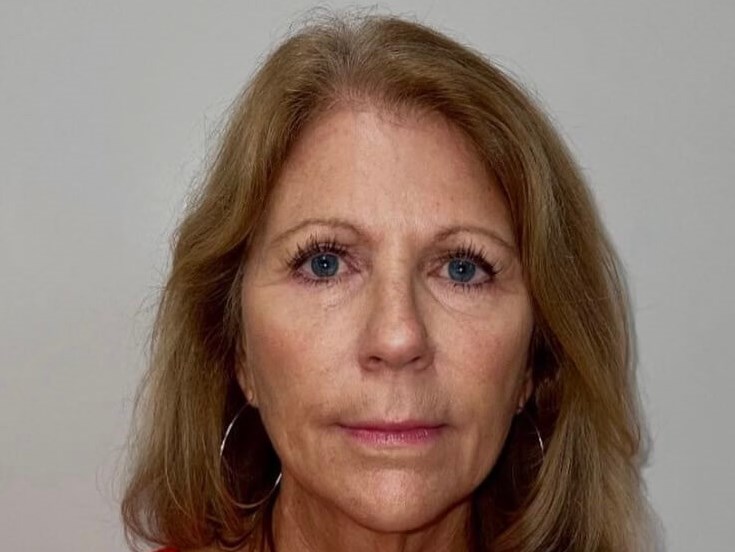 Sculptra Facial Enhancement After