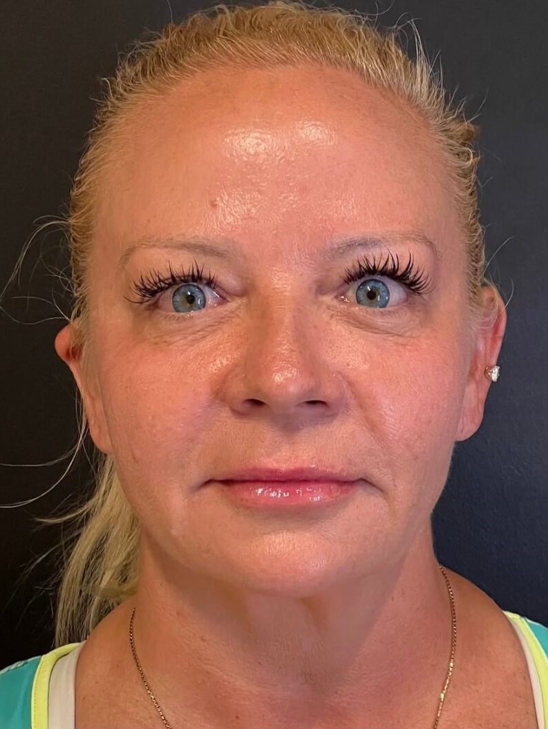 Sculptra Facial Enhancement After