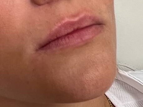 Juvederm Lip Enhancement Before