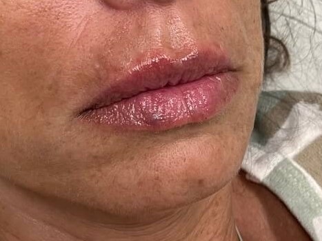 Juvederm Lip Enhancement After