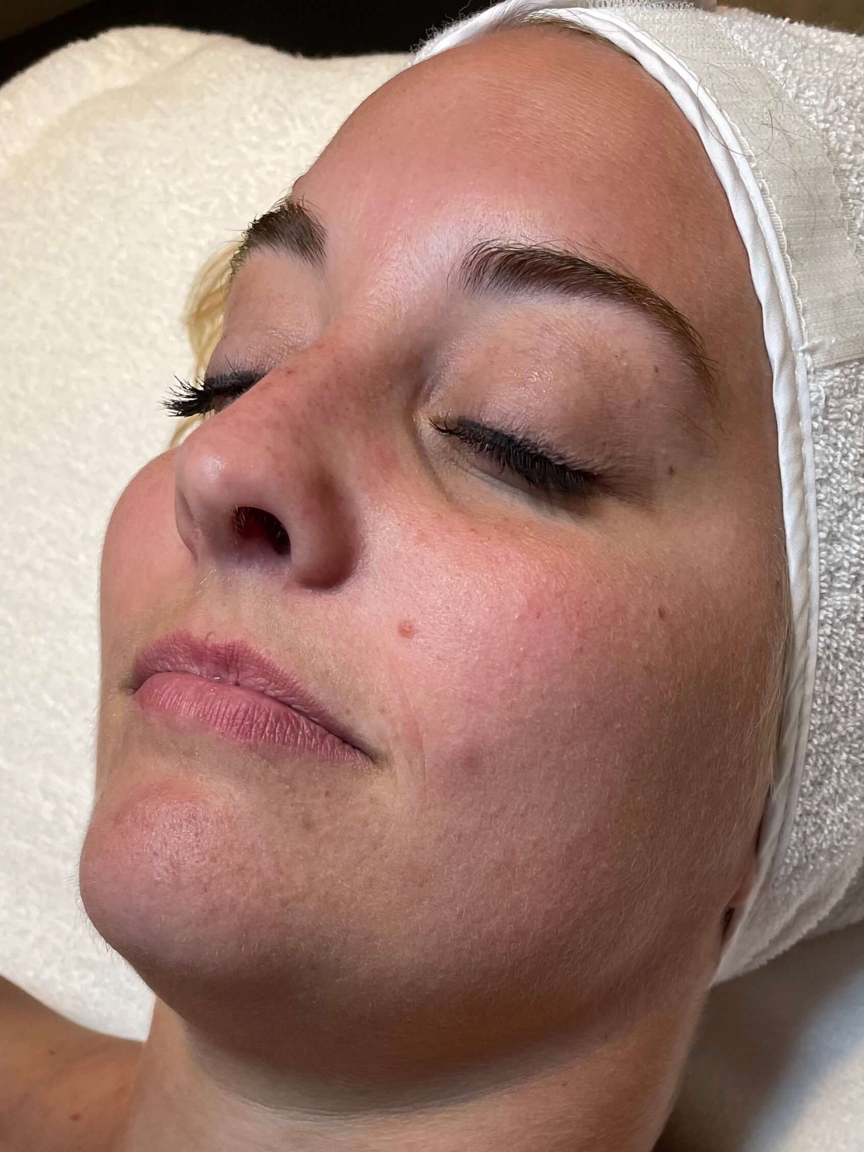 Diamond Glow Facial Before